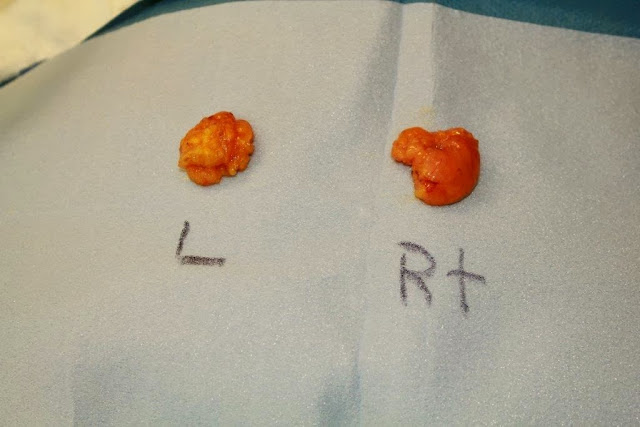 Right Buccal Fat Pad- Facelift surgery Of Marin and Sonoma County Right Buccal Fat Pad- Facelift surgery Of Marin and Sonoma County