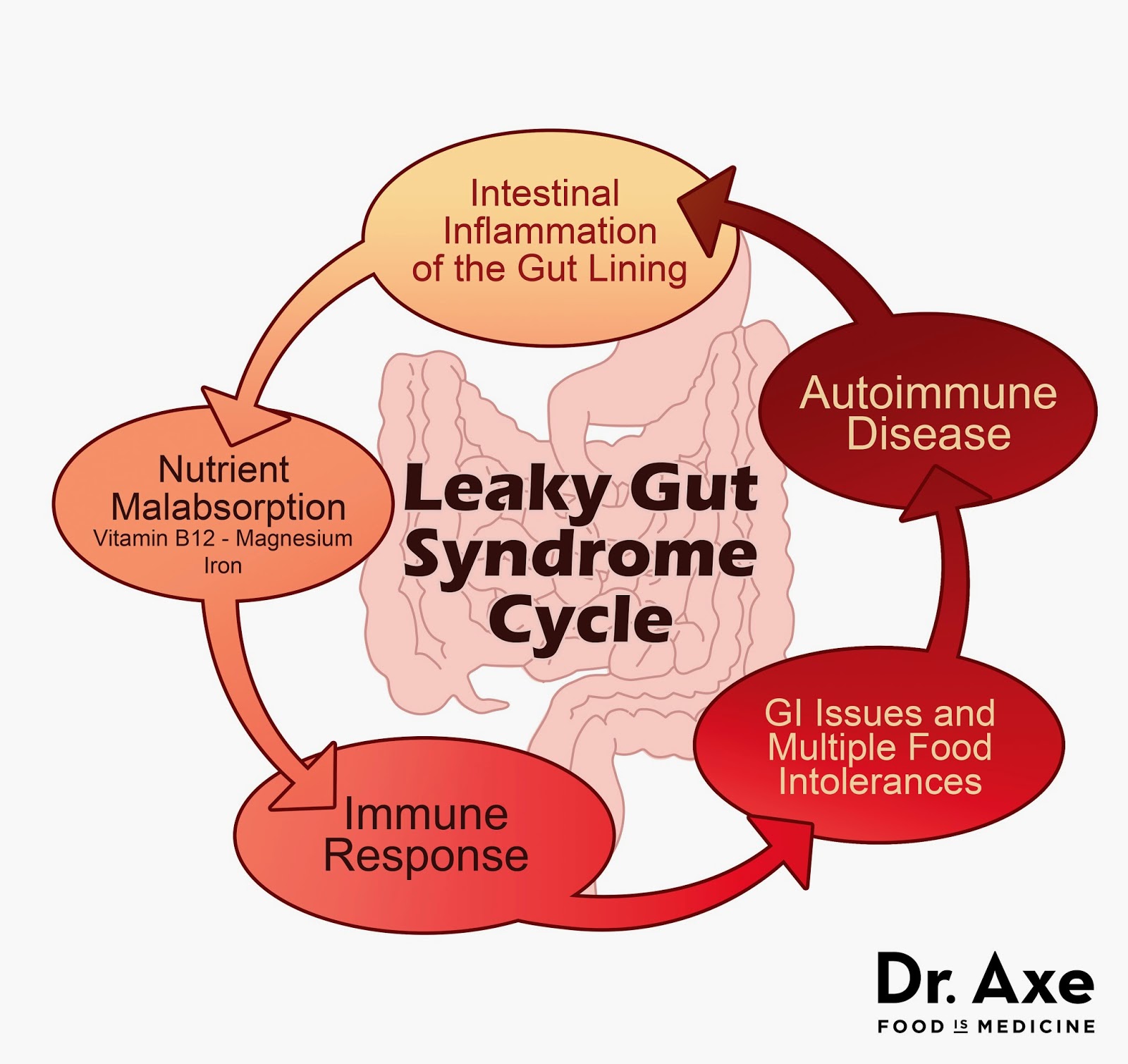 Cristalli colorati La sindrome dell'intestino permeabile (leaky gut