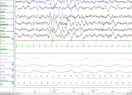 What happens during a sleep study?