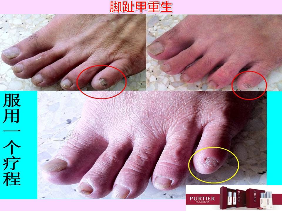 NAILS DISORDER - GROW TO BETTER CONDITION