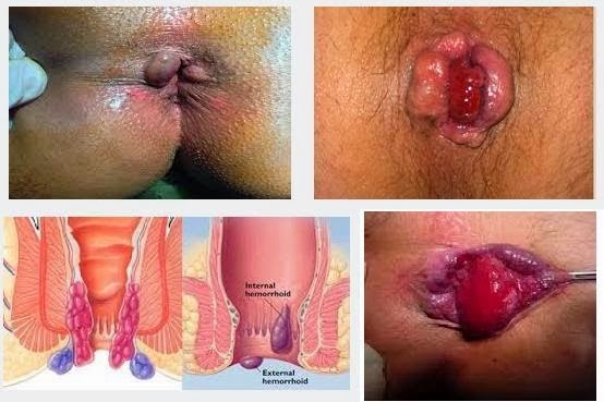 obat herbal untuk penyembuhan wasir, aloe vera obat wasir, cara membuat obat herbal wasir