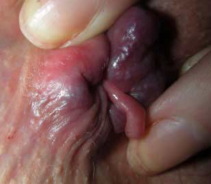 hemorroides