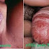 Obat Herbal Untuk Mengobati Sipilis thumbnail