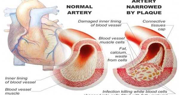 10 Foods That Unclog Arteries Naturally Unclog Arteries Naturally
