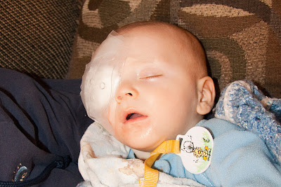 Baby after Cataract Removal