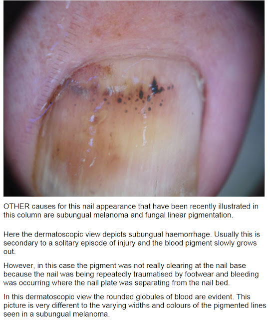 Consultations in Dermatology Subungual hematoma