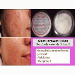 cara menghilangkan bekas jerawat jual kosmetik murah cara menghilangkan bekas jerawat jual kosmetik murah