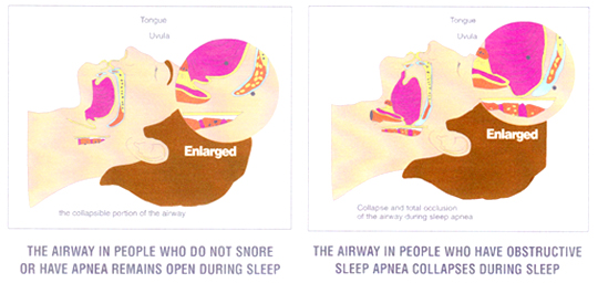 Central Sleep Apnea Causes Obstructive Apnea