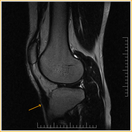 Osgood Schlatter diseaseMRI Sumer's Radiology Blog