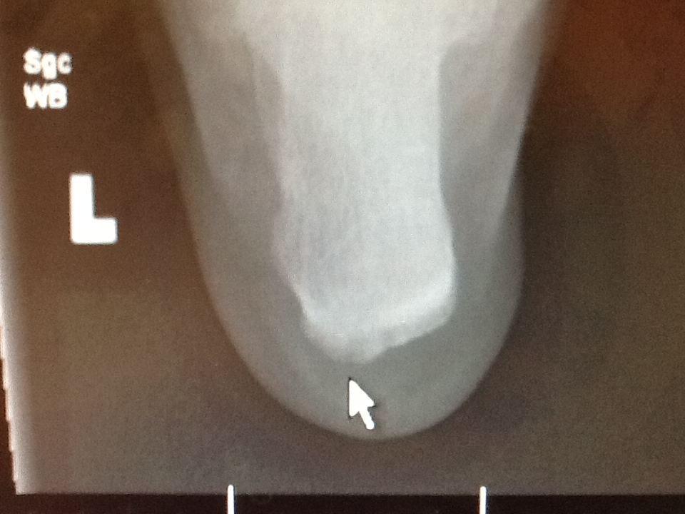 Plantar Fasciitis Patient Handout Spanish