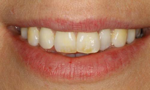 cách tẩy trắng bị vàng cách tẩy trắng bị ố vàng