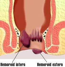 Hemorroides tratamiento