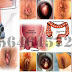 Hemoroid (Wasir) Stadium 4 Apa Harus Operasi thumbnail