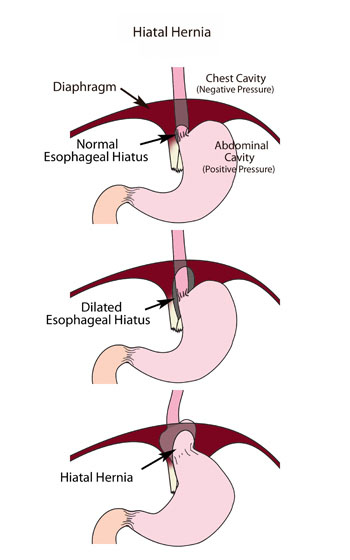 Hiatal Hernia Natural Treatment Options Hiatal Hernia Natural Treatment Options