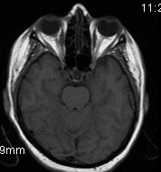 Possible Tolosa Hunt Syndrome Sumer's Radiology Blog