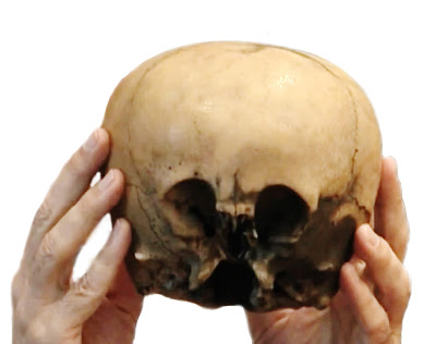 In cursul unor sapaturi arheologice a fost descoperit un craniu neobisnuit, care desi apartinea unui copil prezenta cavitatile creierului neobisnuit de mare. Mister, senzational, extraordinar. Se pare ca acel copil suferea de hidrocefalie, dar ufologii l-au prezentat timp de maimulti ani de zile drept dovada a existentei hibrizilor umano-extraterestrii