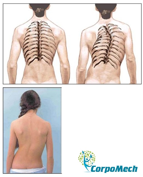 El ejercicio para el tratamiento de la escoliosis