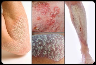 Masalah Psoriasis dan Rawatannya Independent SHAKLEE Distributor, Info, Kongsi, Pengedar Shaklee Kuantan, Produk SHAKLEE, Testimoni, GLA Complex, Vita-E, B-Complex, Nutriferon, Omega Guard, Vivix,