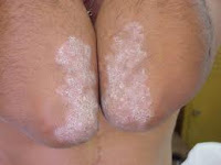 Psoriasis