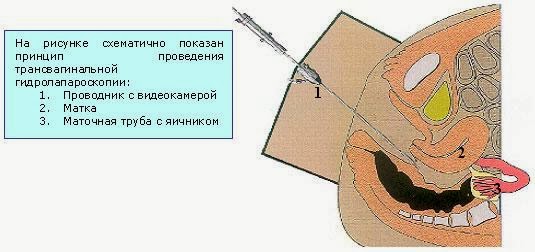 Определение проходимости маточных труб в домашних условиях