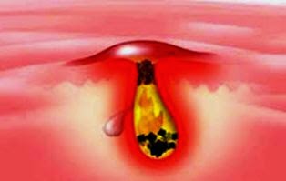 Obat Jerawat Yang Paling Ampuh Obat Jerawat Yang Paling Ampuh
