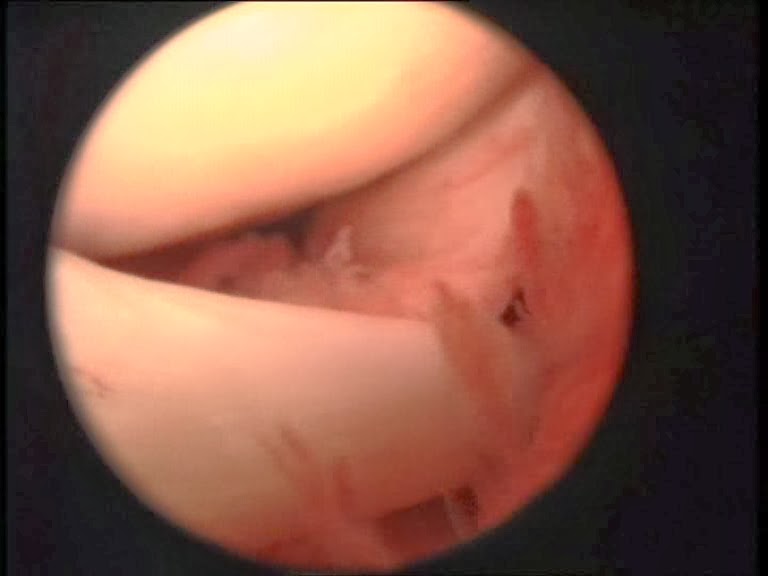 imagenes artroscopicas meniscos y ligaemntoa artroscopia rodilla perro