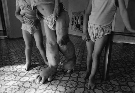 Trinoble Birth Defects