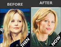 Botox Antes y despues