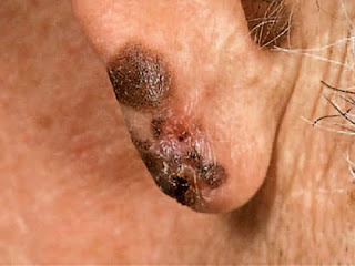 Symptoms Skin Cancer