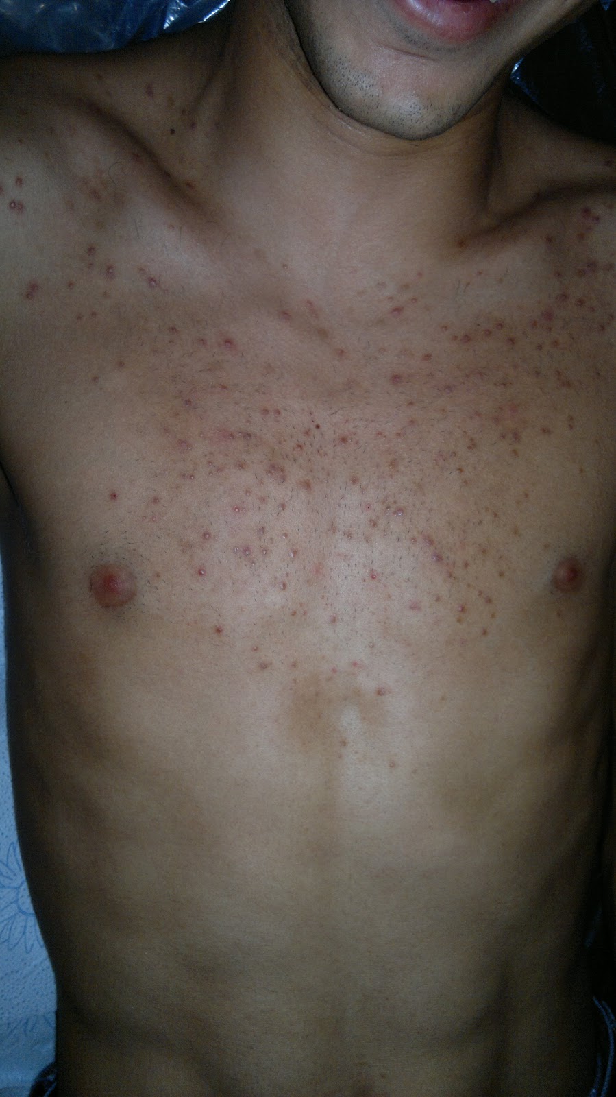 Fungal Folliculitis Pictures