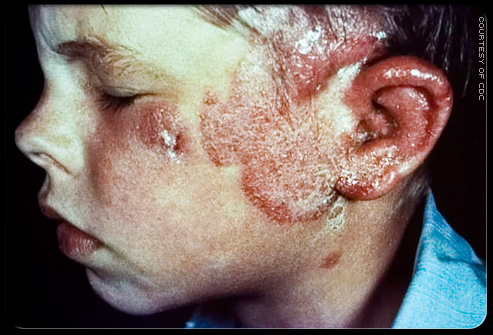 Interior Nose Ring Burn Interior Nose Ring Burn