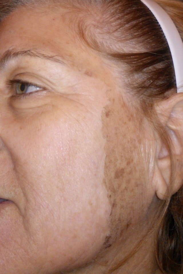 Elite Therapeutics Body and Skin Care Jessner Peel