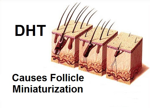 Dht And Hair | hair loss dht and hair loss in women Dht And Hair | hair loss dht and hair loss in women