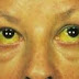 Obat Alami Alternatif Penyakit Kuning thumbnail