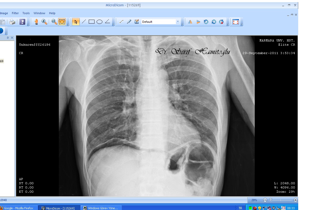 Peptic Ulcer as related to Flaxseed Pictures