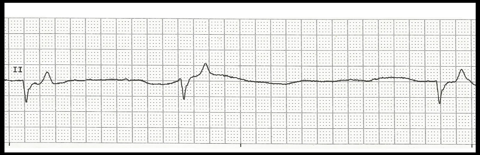 Float Nurse Practice EKG Strips