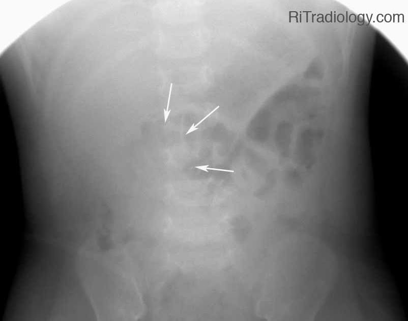 RiT radiology Intussusception Reduction
