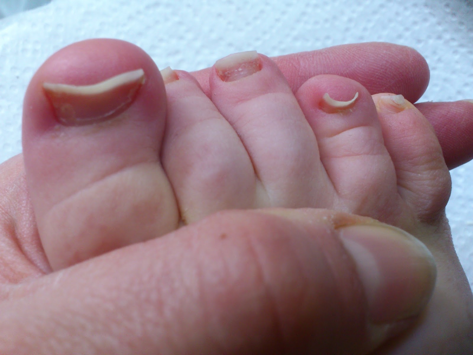 10. Foot Nail Color Changes and Skin Cancer - wide 10
