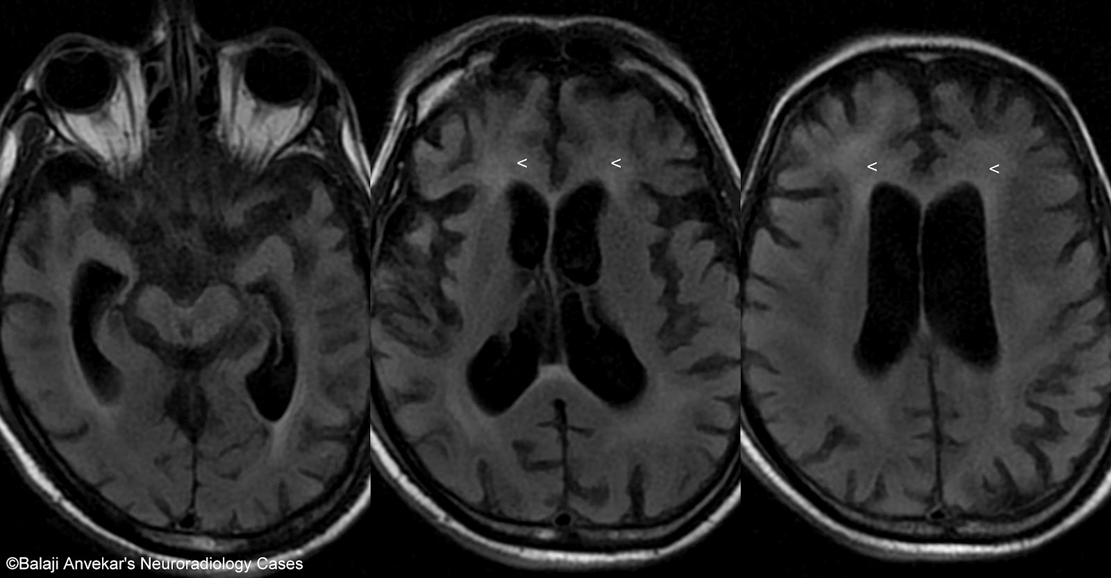 Is Hiv Hiding In Your Brain Mri Scans Can Identify Virus From Changes
