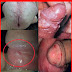 Aduh, Penis Bentol dan gatal gatal di selakangan..Bagaimana Mengobatinya? thumbnail