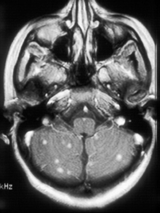 Cns Tuberculoma