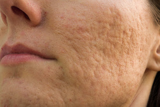 Como Eliminar Las Cicatrices De Acne Como Eliminar Las Cicatrices De Acne