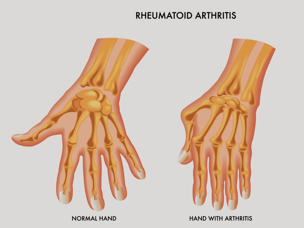 Most Common Signs and Symptoms of Early Onset Arthritis Churchill