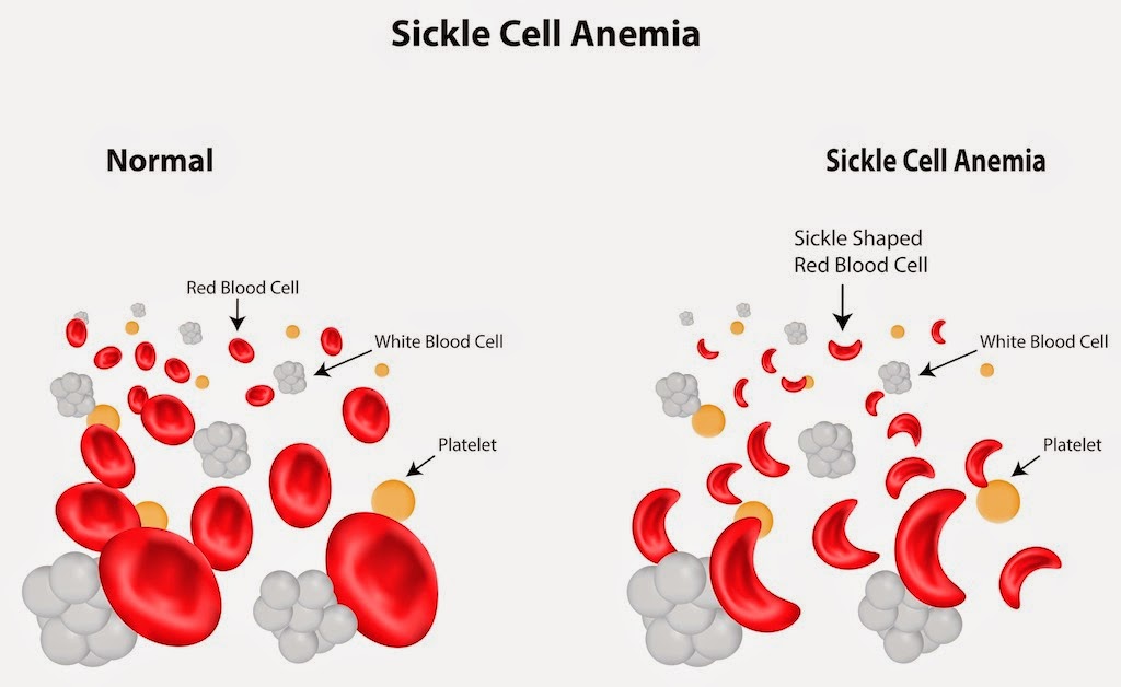 sickle cell hemoglobin anemia abnormal red caused