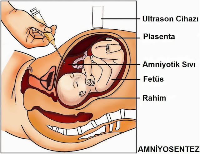 amniyosentez kimelere yapılır, amniyosentez neden yapılır