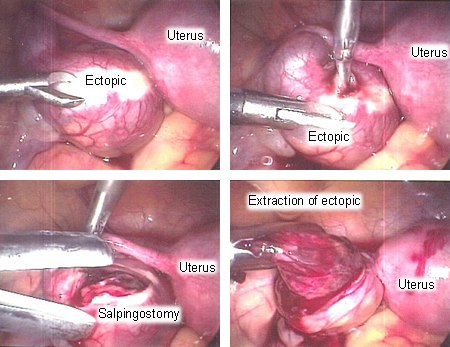 Communication on this topic: What Is Tubal Ligation, what-is-tubal-ligation/ Communication on this topic: What Is Tubal Ligation, what-is-tubal-ligation/