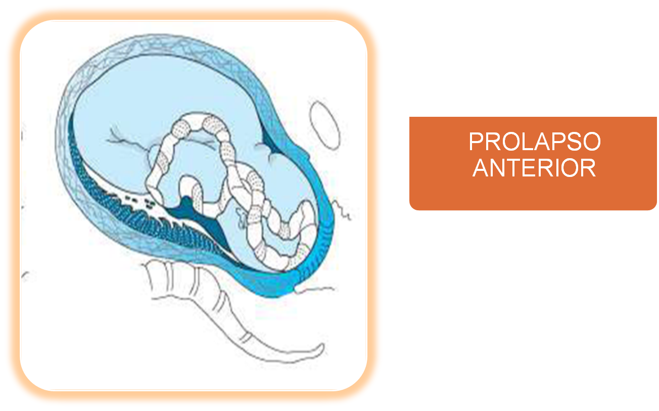 PROLAPSO DE CORDÓN "Obstetricia I"