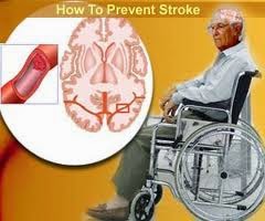 Penyebab Penyakit Stroke Penyebab Penyakit Stroke