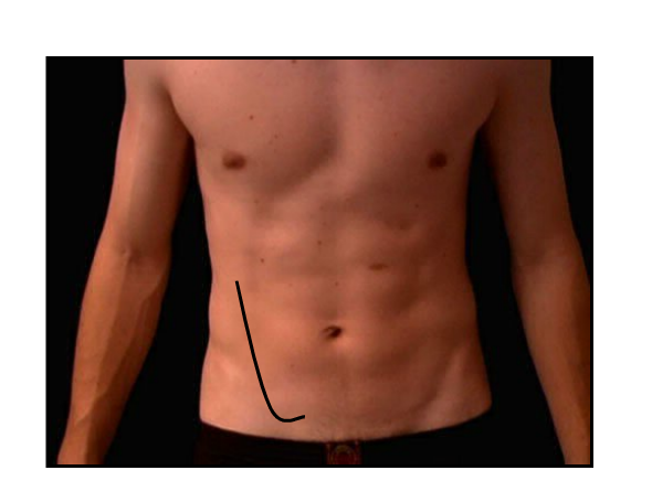 McBurney's+Incision ... from mcburney incision. it will be performed when appendix is