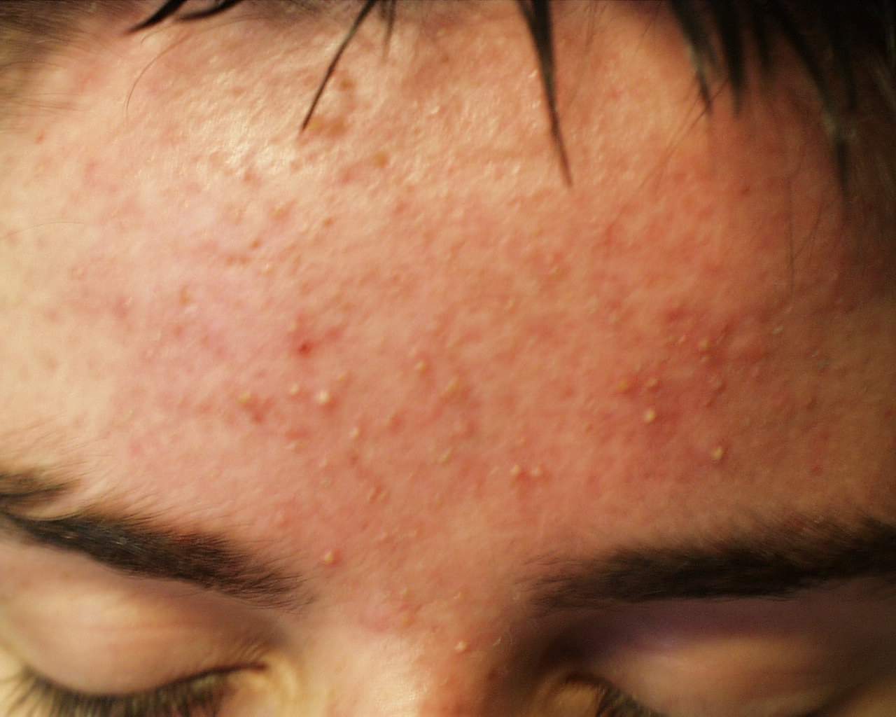 Medicina di acne forte
